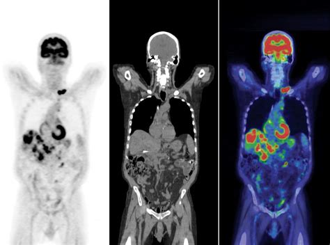 Can I Eat Nuts Before a PET Scan? Exploring the Intersection of Snacking and Medical Imaging